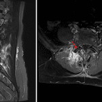 Right L4-L5 facet joint effusion (red arrows) with surrounding edema (as noted on the sagittal STIR image on the left) and enhancement (as noted on the axial post-contrast image on the right) in the adjacent bones and soft tissues.