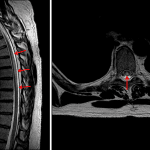Abnormal T2 signal hyperintensity in the central and dorsal aspects of the mid thoracic spinal cord (red arrows) in this patient with transverse myelitis.