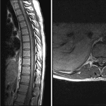 CSF pulsation in the dorsal subarachnoid space in the upper and mid thoracic spine. Notice how signal loss is more pronounced on T2-weighted than T1-weighted sagittal sequences because T2-weighted sequences have longer TE. Also notice how signal perturbation is more pronounced on the axial (perpendicular to CSF flow) T1-weighted sequence than on the sagittal (parallel to CSF flow) T1-weighted sequence.