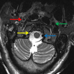 Axial T2-weighted MR images at the level of C2 (left) and the skull base (center) and CTA axial image at the skull base (right) show abnormal flow-related signal loss and abnormal contrast filling in the right internal carotid (red arrows) and vertebral (yellow arrows) arteries compared to the normal left internal carotid (green arrows) and vertebral (blue arrows) arteries.