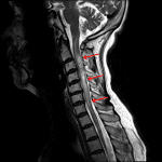 Longitudinally extensive cervical spinal cord lesion (red arrows) with areas of marked T2 hyperintensity equal or greater to that of CSF in this patient with neuromyelitis optica.