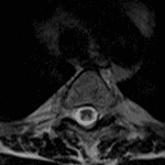 Triangular area of T2 signal hyperintensity in the dorsal aspect of the cord (outlined in red) in this patient with subacute combined degeneration.