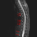 STIR signal hyperintensity in the endplates along the anterior aspects of the discovertebral joints at multiple levels (red arrows) consistent with changes of enthesitis.