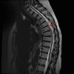 Ventral displacement of the thoracic spinal cord with dorsal cord indentation (red arrow), which in this case is concerning for the presence of an arachnoid web.