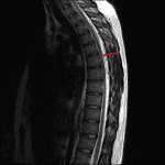 Focal ventral deviation of the cord with abnormal indentation of the dorsal margin of the cord (red arrow) in this patient with a dorsal arachnoid web.