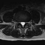 Empty thecal sac sign of arachnoiditis, which is the result of peripheral adherence of inflamed nerve roots of the cauda equina.