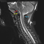 Atlantooccipital dissociation injury with uplifting of the tectorial membrane from the clivus (red arrow), edema/hemorrhage in the supraodontoid space (yellow arrow), and evidence of injury to the C1-C2 interspinous ligament (blue arrow).