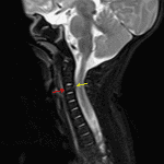 Marrow edema in the C3 vertebral body concerning for acute nondisplaced fracture (red arrow). Adjacent focal disruption of the posterior longitudinal ligament (yellow arrow).