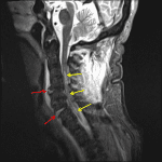 Extensive ligamentous injury in the cervical spine including focal disruptions of the anterior longitudinal ligament at two levels (red arrows). Long segment spinal cord contusion (yellow arrows).