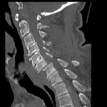 Sagittal reformatted image from the preceding CT in this patient.