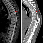 Ventral cord herniation through a dural defect (red arrows) shown on a preoperative MRI and subsequent CT myelogram which was performed after the patient did not have symptom relief from multilevel laminectomies and fenestration of the dorsal thecal sac.