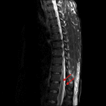 Linear T2/STIR hyperintensity extending from the posterior paraspinal soft tissues through the dura into the spinal cord (red arrows) concerning for dural and spinal cord laceration.