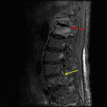 Discitis/osteomyelitis at the thoracolumbar junction (red arrow) with separate septic facet arthritis in the lower lumbar spine (yellow arrow).