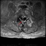 Peripherally enhancing collection in the right dorsal epidural space at the level of L5 (red arrow) consistent with an epidural abscess.