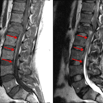 Ventral epidural collection (red arrows) that is hyperintense on T1-weighted images (left) and iso- to mildly hyperintense on T2-weighted images (right) consistent with an epidural hematoma.