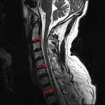 Ventral epidural hematoma with uplifting of the dura (red arrows).