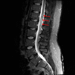 STIR signal hyperintensity in the conus (red arrows) in this patient with suspected fibrocartilaginous embolism.