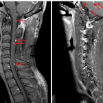 Multiple nodular intramedullary lesions in the cervical spinal cord and cerebellum (red arrows) consistent with hemangioblastomas in this patient with von Hippel Lindau disease.