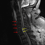 Focal disruption of the anterior longitudinal ligament at multiple levels (red arrows) and ventral epidural hematoma (yellow arrows), best shown on this sagittal STIR sequence.