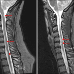 Multiple short segment T2/STIR hyperintense lesions in the cervical spinal cord (red arrows) in this patient with multiple sclerosis.