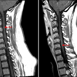 Enhancement associated with two of these lesions (red arrows) concerning for areas of active demyelination.