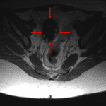 Enlarged right ovary with peripheralization of ovarian follicles (red arrows) concerning for ovarian torsion.