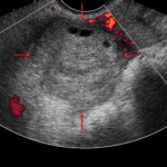 Subsequent ultrasound from the same patient showing an enlarged right ovary with heterogeneous echogenicity and lack of appreciable blood flow (red arrows), consistent with ovarian torsion.