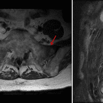 Bilateral sacral insufficiency fractures evidenced by linear areas of T1 signal hypointensity in both sacral ala (red arrows) and surrounding STIR signal hyperintensity (yellow arrow).