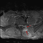 Enhancement in and surrounding the left L5-S1 facet joint (red arrows) consistent with septic facet arthritis.