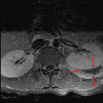 Left posterior perinephric peripherally-enhancing collection (red arrows) concerning for abscess.