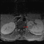 Relatively hypoenhancing lesion in the medial interpolar left kidney (red arrow) concerning for developing abscess.