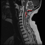 Intramedullary mass in the dorsal aspect of the cervicomedullary junction with heterogeneous internal signal and a peripheral T2 hypointense rim (red arrows), compatible with a spinal cavernoma.