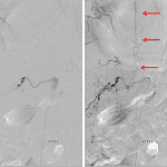 Subsequent angiogram in this patient with early (left) and slightly delayed (right) images demonstrating an arteriovenous fistula associated with the right T11 segmental artery with rapid filling of dilated perimedullary veins (red arrows).