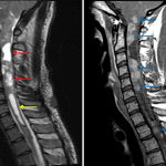 Long segment expansile intramedullary tumor with cystic components (red arrows), a caudal cyst versus syrinx (yellow arrow), and heterogeneous enhancement (blue arrows) most consistent with an ependymoma.