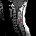 Enhancing intradural, extramedullary mass at the level of C5-C6 (red arrow) consistent with a spinal meningioma.