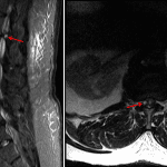 T2/STIR hyperintense structure along the medial aspect of the right L1-L2 facet joint (red arrows) with associated cord compression, concerning for a synovial cyst.