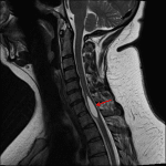 Syrinx at the cervicothoracic junction (red arrow).