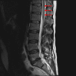 Thin cystic structure in the central aspect of the lower thoracic spinal cord and conus (red arrows) consistent with a terminal ventricle.