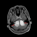 Postcontrast brain MRI from the same patient showing large bilateral cerebellopontine angle vestibular schwannomas extending into the internal auditory canals (red arrows).