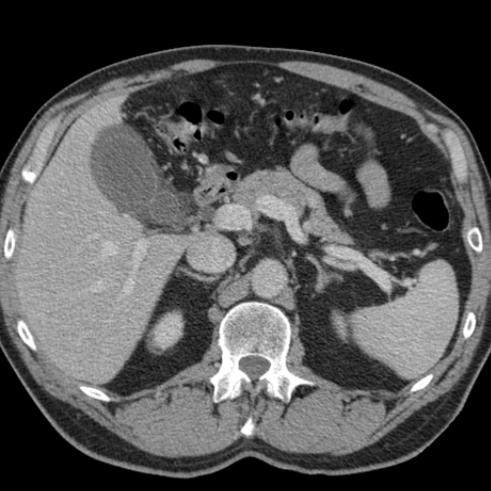 CaseStacks.com - Upper Abdominal Pain on Body CT
