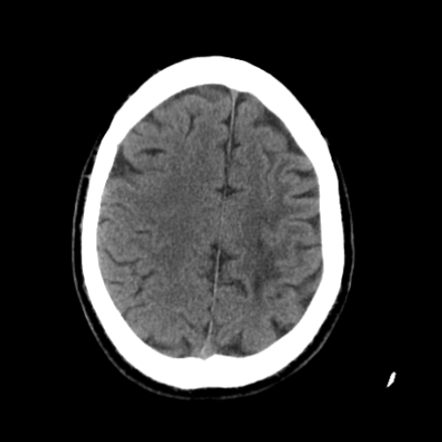 Neuro CT