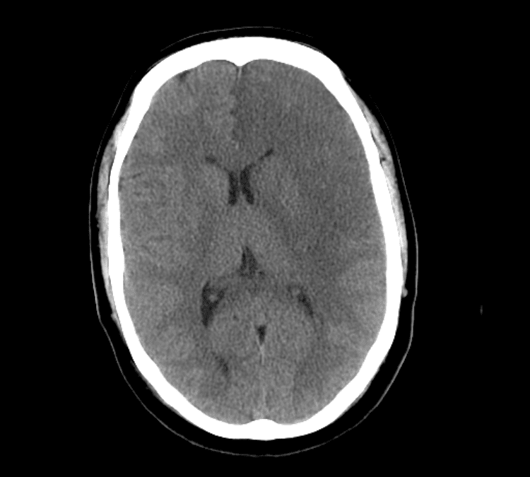 Non-traumatic Head CT Cases