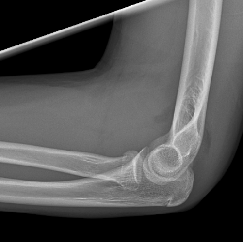 CaseStacks.com - Pediatric Elbow & Forearm Radiograph Cases