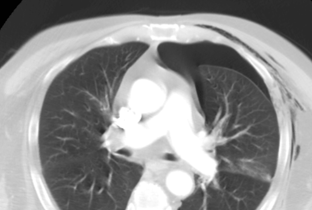 Chest CT