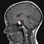 T1 hyperintense sellar mass with suprasellar extension