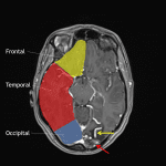 Locations of the frontal, temporal, and occipital lobes on this axial cross-section. Red arrow shows the location of the AVM nidus. Yellow arrow shows a dilated draining vein.