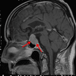 The red arrows show the mass on each of the three sequences.