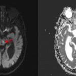 Red arrows show the location of the infarct on each sequence.