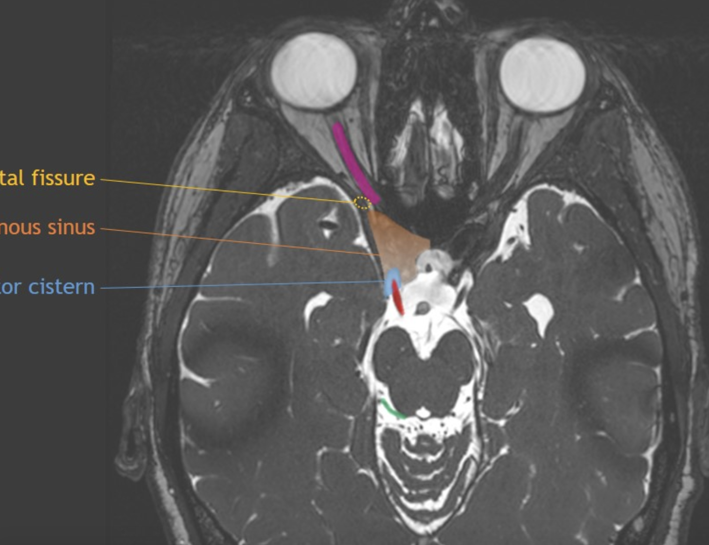 CaseStacks.com - Cranial Nerve Anatomy on MRI