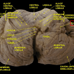 Inferior View of the Cerebellum. Anatomist90 / CC BY-SA (https://creativecommons.org/licenses/by-sa/3.0) via WikiMedia https://upload.wikimedia.org/wikipedia/commons/2/2c/Slide2SEER.JPG